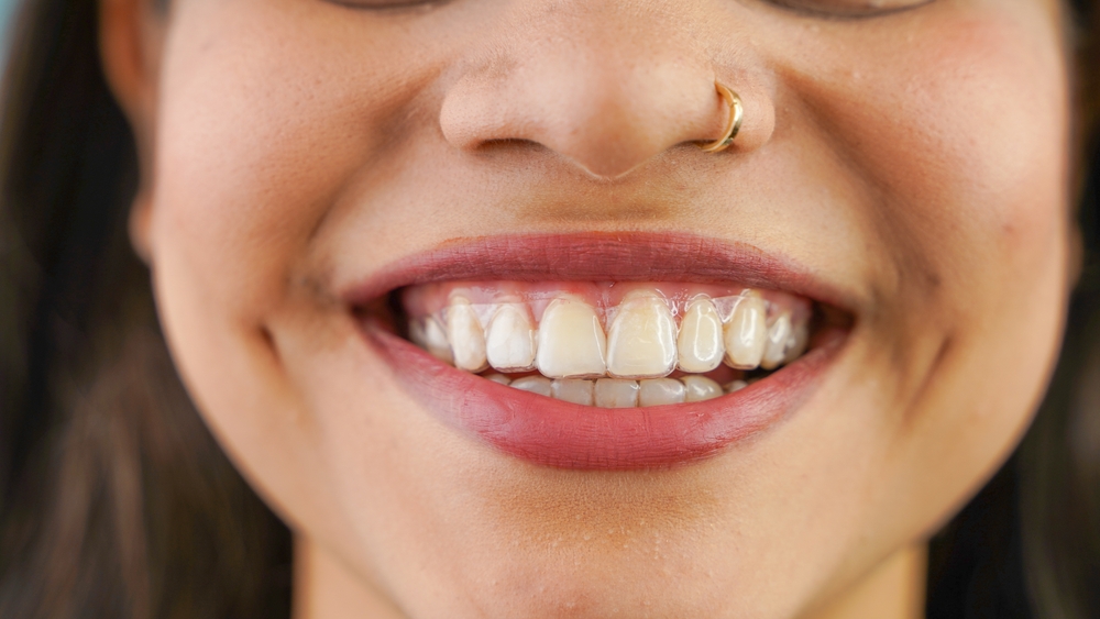 Invisalign in Edmond, OK